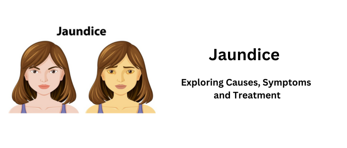 Jaundice: Exploring Causes, Symptoms and Treatment